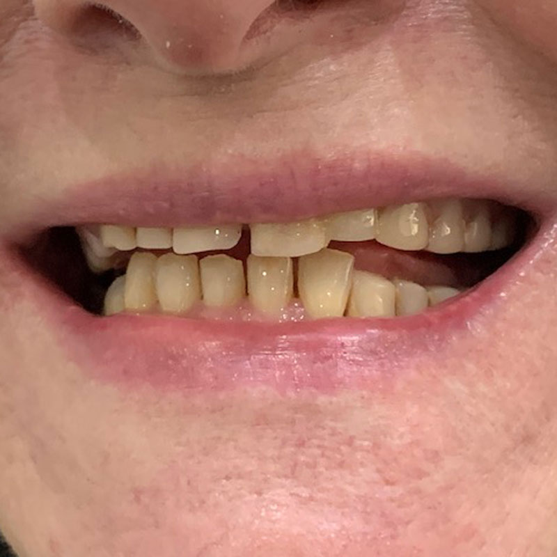 Dentures, before - The Denture Clinic, Deal