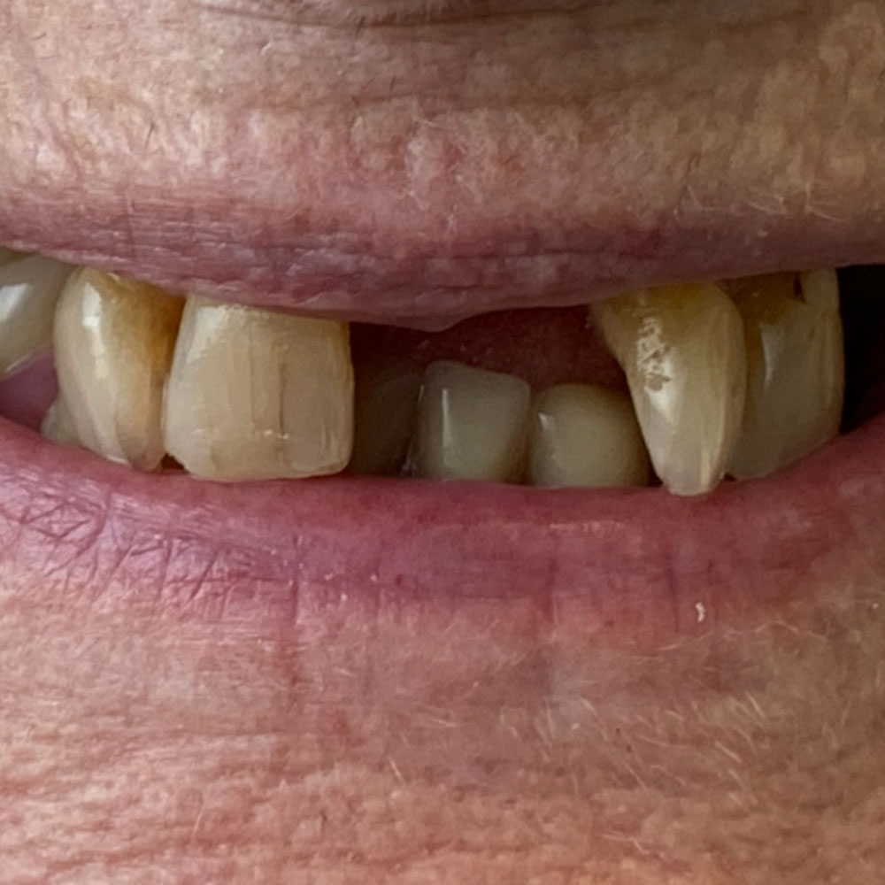 Partial dentures, before - The Denture Clinic, Deal